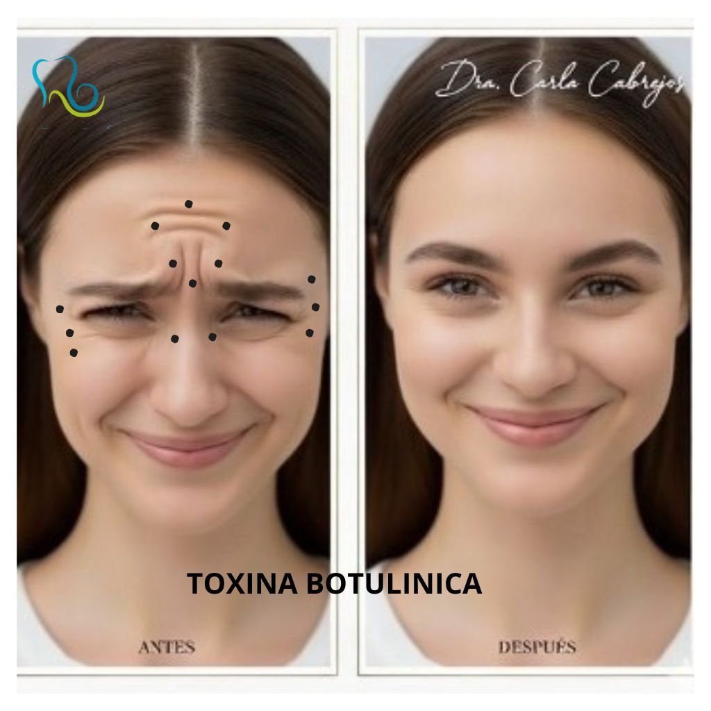 TOXINA BOTULINICA
