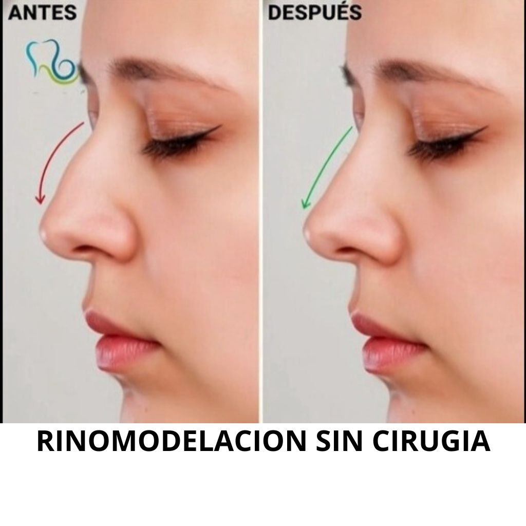 RINOMODELACION SIN CIRUGIA