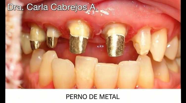 PERNO DE METAL