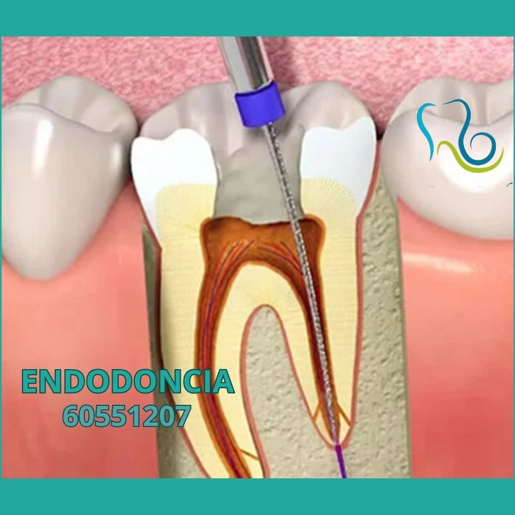 ENDODONCIA