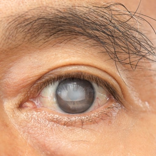 Glaucoma
