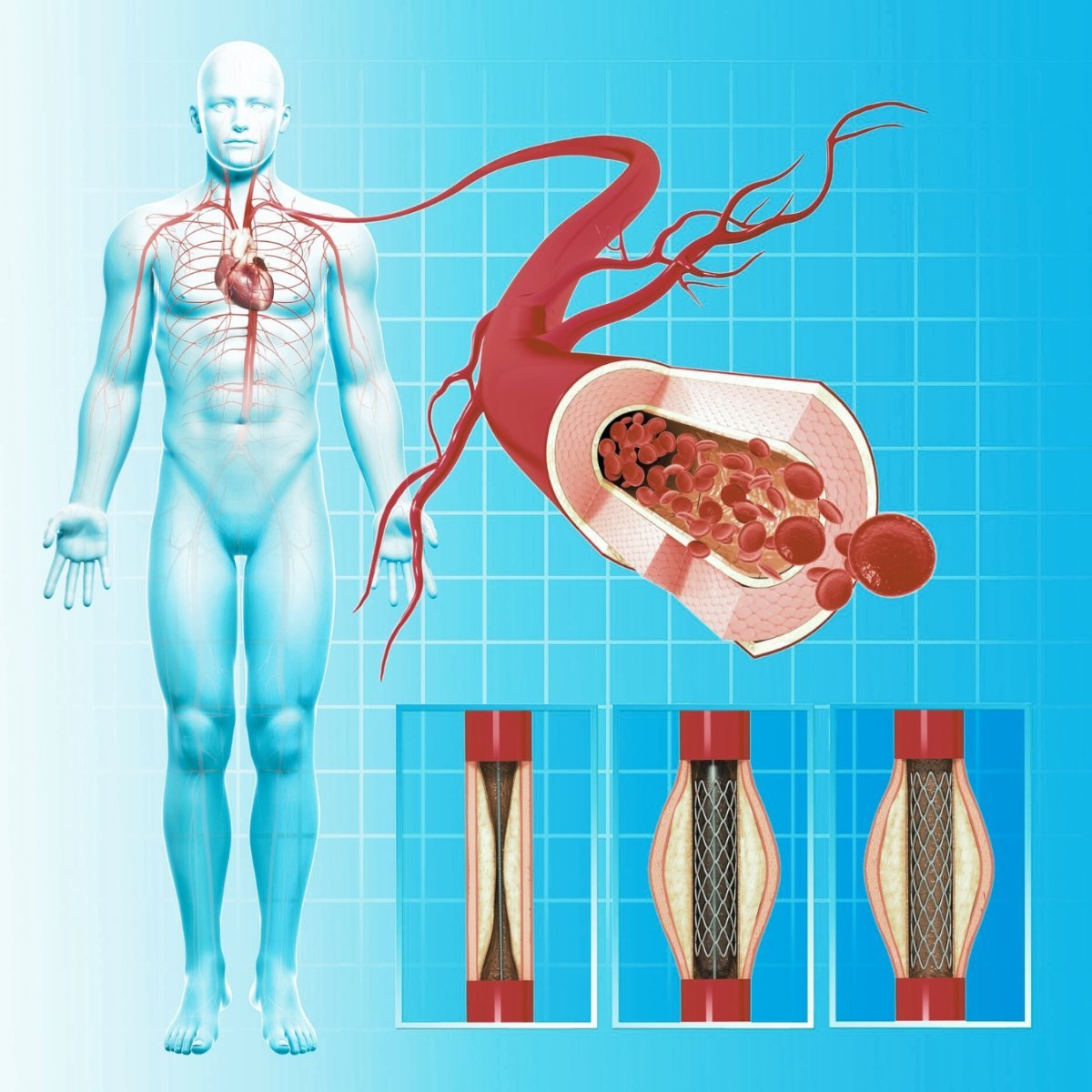 Seguimiento de pacientes post angioplastia