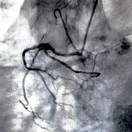 Cateterismo cardíaco