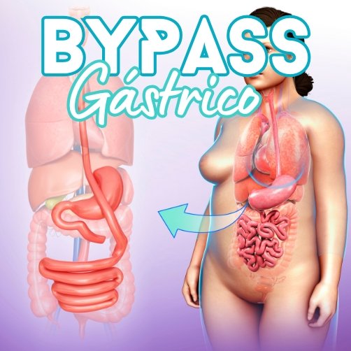 Bypass Gástrico