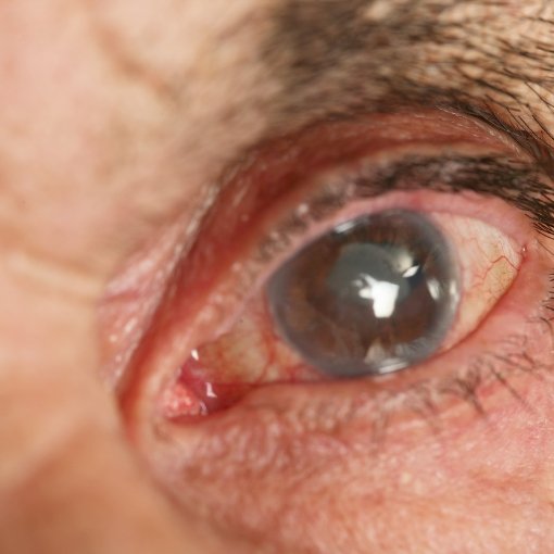 Tratamiento clinico y quirúrgico del glaucoma